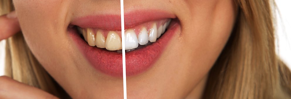 whitener teeth